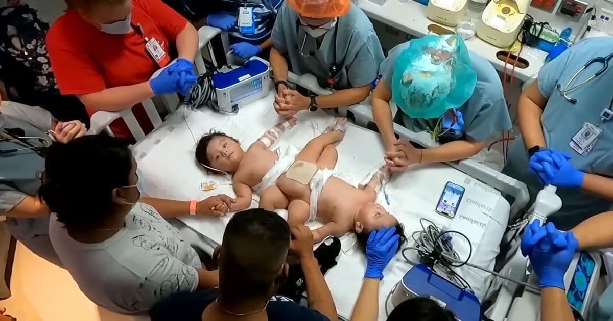conjoined twins separated in texas 2023